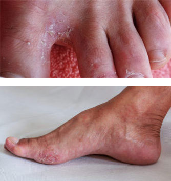 Athletes’ foot (Tinea pedis or Onchomycosis)