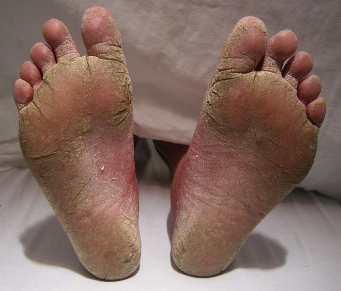 Fungal infection with bacterial superinfection