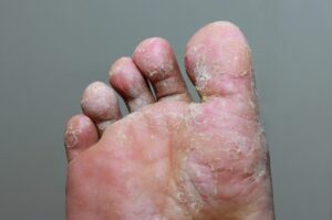 Athlete’s foot