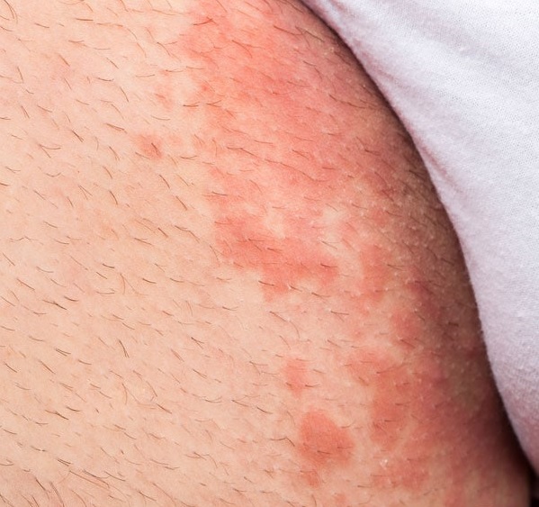 Jock itch (tinea cruris)