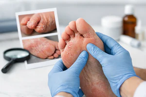 Tinea Pedis Symptoms and Pictures Guide