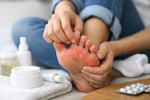 Itching Burning Foot Rash Relief That Works