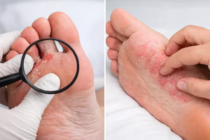 Tinea Pedis vs Eczema: How to Tell